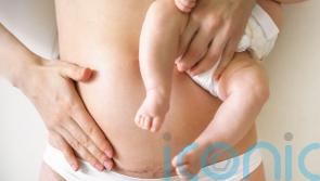 5 myths and misconceptions about caesareans everyone needs to stop believing