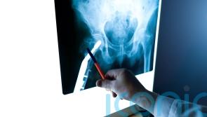 Streeting urged to honour promise to end osteoporosis service postcode lottery