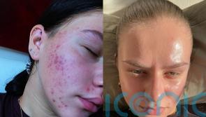 ‘Kids at school called me pizza face, spotty and ugly because of my acne – an advert on social media changed my life’