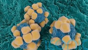 Rapid treatment prevents need for life-changing surgery for rectal cancer