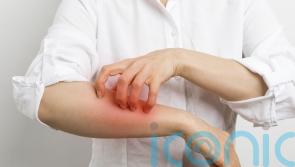 How to spot, treat and prevent scabies