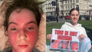 I would do anything to have eczema again, says 20-year-old afflicted by ‘burning’ and ‘oozing’ steroid cream withdrawal