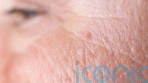 Melanoma awareness month: Is it an age spot or skin cancer?