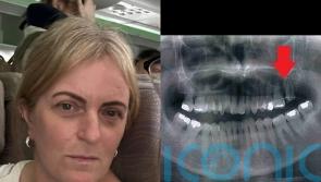 Mum receives £10,000 settlement after dentist broke her jaw during tooth extraction and bone later came out in her hand