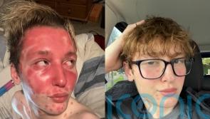 Influencer left looking ‘like an alien’ after fillers triggered psoriasis finds miracle product to soothe painful skin