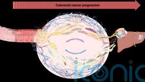 Bowel cancer cells can ‘shapeshift’ to enable aggressive spread, research finds
