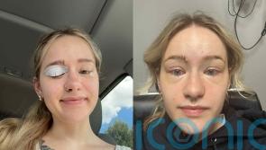Young woman, 23, with extreme dry eye condition who needs drops made from own blood urges others to ‘cherish’ eye health