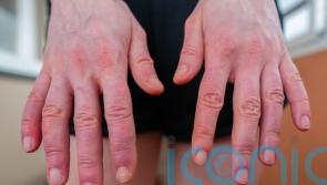 Why do my hands and feet swell in the summer?