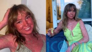 Woman bullied for rare condition making her one of ’40 reported cases worldwide’ says scaly skin is ‘cool and unique’