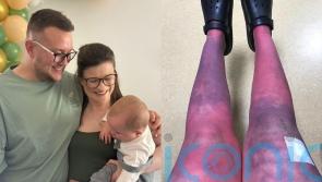 ‘It’s like I’m burning alive’ – Mum says rare condition robbed her of ‘everything’ from motherhood to independence