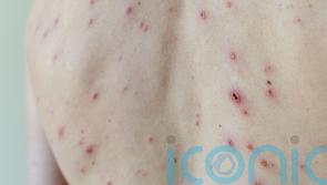 Minister urges take-up of chickenpox jab to defeat vaccine conspiracy theorists