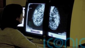 AI could detect heart risk from breast screening images, study suggests