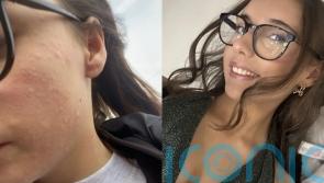 &lsquo;I want a normal life&rsquo;: Girl, 16, allergic to the cold comes out in hives when temperature is below 12 degrees Celsius