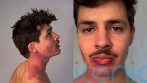 Twin with port wine stain on face says he feels &lsquo;lucky&rsquo; to be different and now champions self-acceptance after coming out as gay