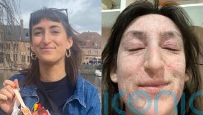 Woman &lsquo;left bedbound and unrecognisable with oozing, elephant-like skin&rsquo; after 28 years of steroid cream use for eczema