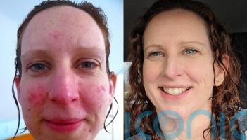 Mum left with red skin for months after face turned into ‘red-hot furnace’ cooking Christmas dinner finds miracle cure