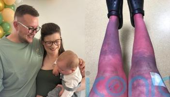‘It’s like I’m burning alive’ – Mum says rare condition robbed her of ‘everything’ from motherhood to independence