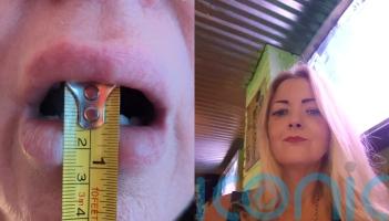 A mum whose jaw only opens 14mm after decades of pain says she is deteriorating as the NHS ‘continues to ignore’ her