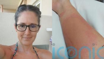 ‘I’m allergic to the cold – I break out in hives like nettle stings and my skin is so itchy I want to rip it off’