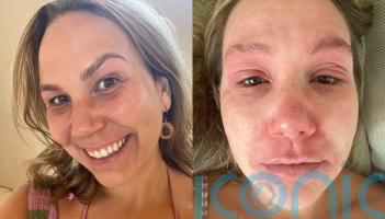 &lsquo;I used steroid creams for 10 years and the withdrawal left me in never-ending agony &ndash; recovery has taught me self-love&rsquo;