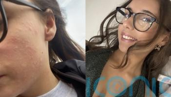 &lsquo;I want a normal life&rsquo;: Girl, 16, allergic to the cold comes out in hives when temperature is below 12 degrees Celsius