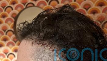 Student to be &lsquo;first in queue&rsquo; as new brain tumour treatment approved for NHS