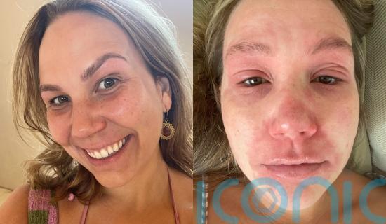 &lsquo;I used steroid creams for 10 years and the withdrawal left me in never-ending agony &ndash; recovery has taught me self-love&rsquo;