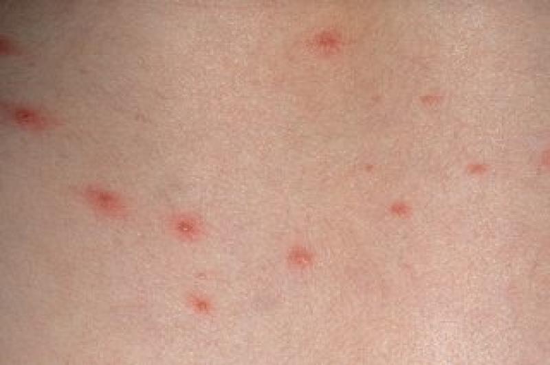 Concerns about increase in chickenpox cases in Ireland