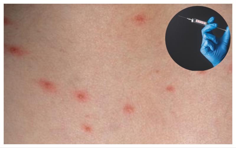 Welcome news for parents as chickenpox vaccine to be made free for children