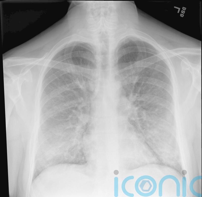Lung disease deaths highest in western Europe, charity warns in call for action