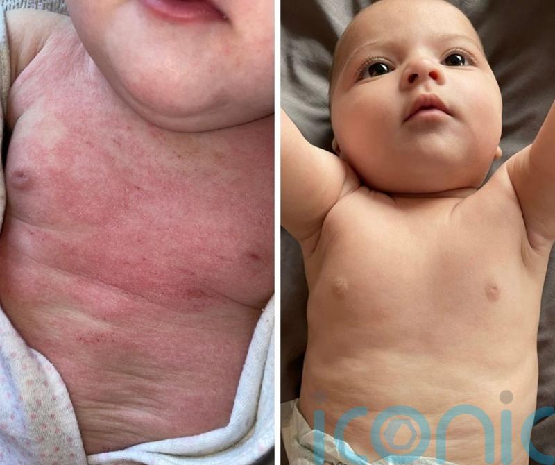 Adorable baby so coated in angry red eczema she wears socks on her hands to prevent scratching is “cured overnight” by £7.99 cream