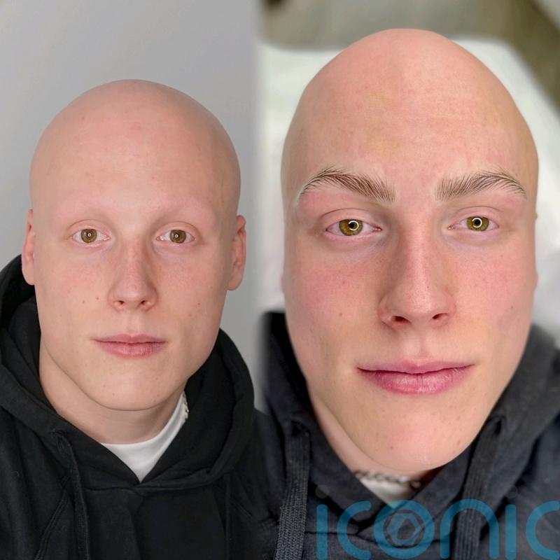 Student who loses his head and body hair at 15 saying GCSE stress caused alopecia has eyebrow tattoos inspired by mum’s beauty treatments
