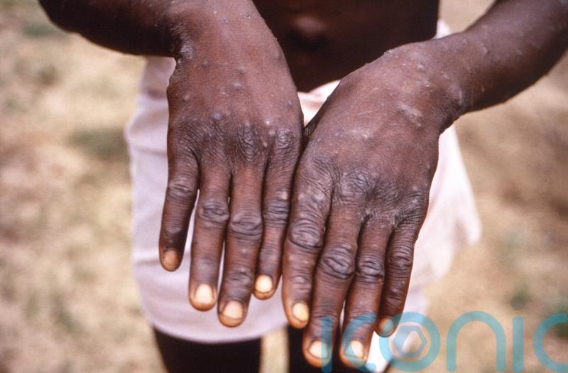 New monkeypox guidance tells high-risk close contacts to isolate for 21 days