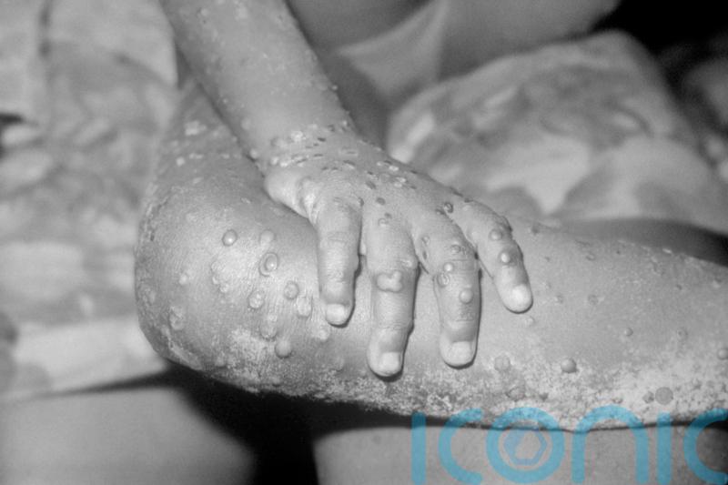 Number of monkeypox cases in UK rises to 57