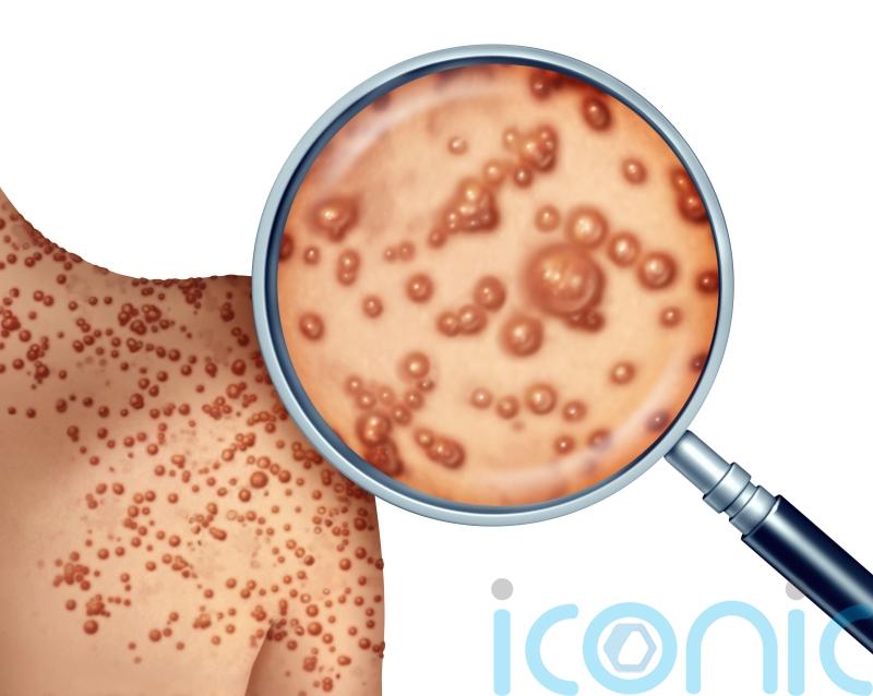 How to tell the difference between monkeypox and chickenpox in your child