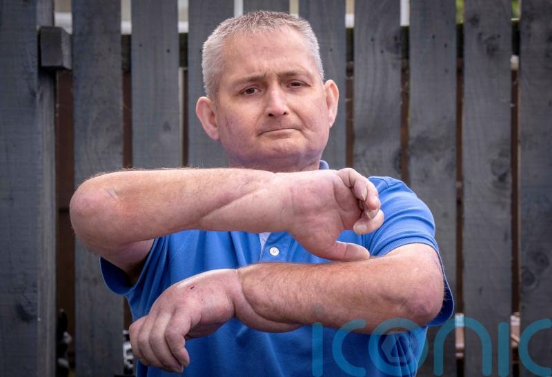 Man has double hand transplant in ‘world first’ for scleroderma patient