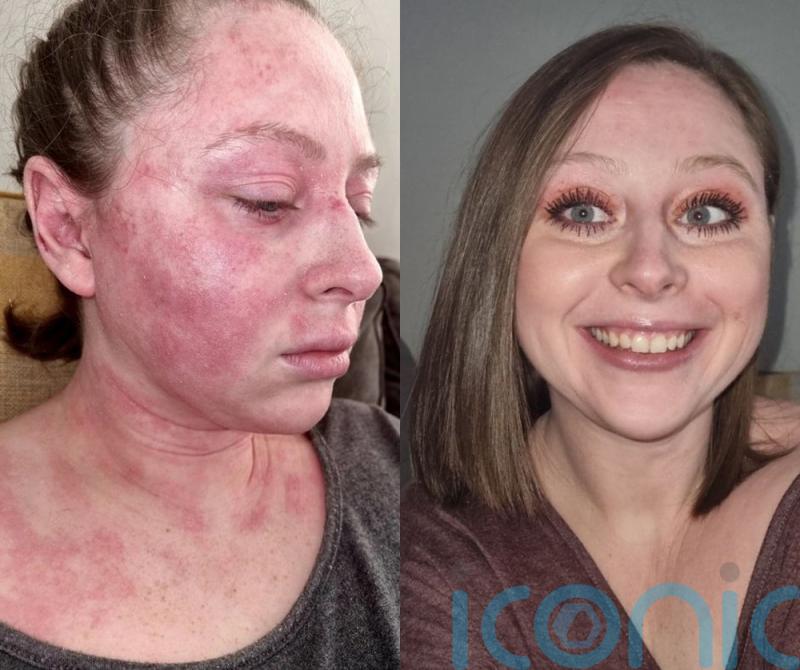 Call centre worker bedbound by eczema leaving her balding and sleeping in balaclava to stop her face sticking to sheet clears it with £9 cream