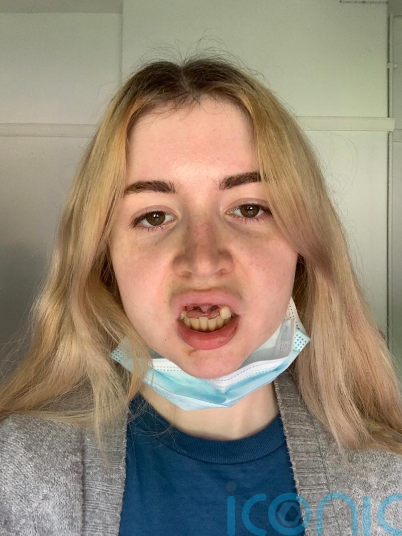 Gamer branded “bunny” due to goofy teeth fundraises for £18k implants as she knocks them out in a fall