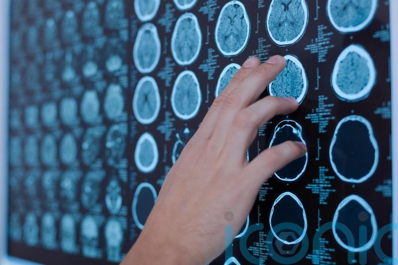 Researchers hope simple test can help diagnose brain tumours quicker