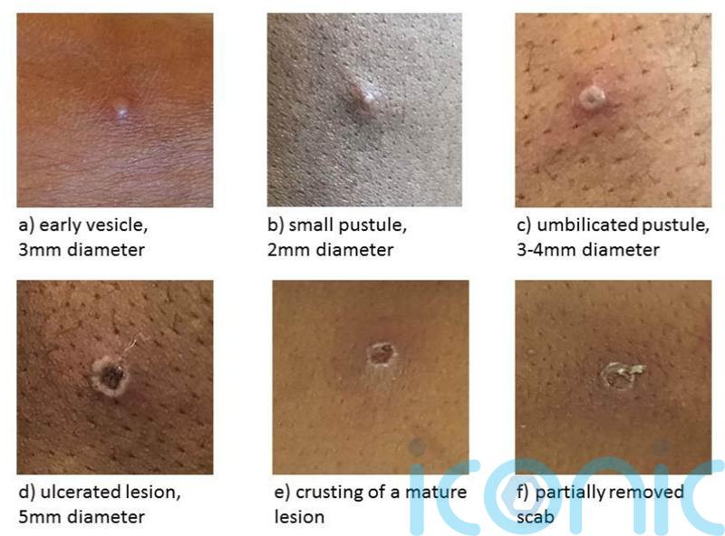 Monkeypox cases in Scotland increase to 18, figures show