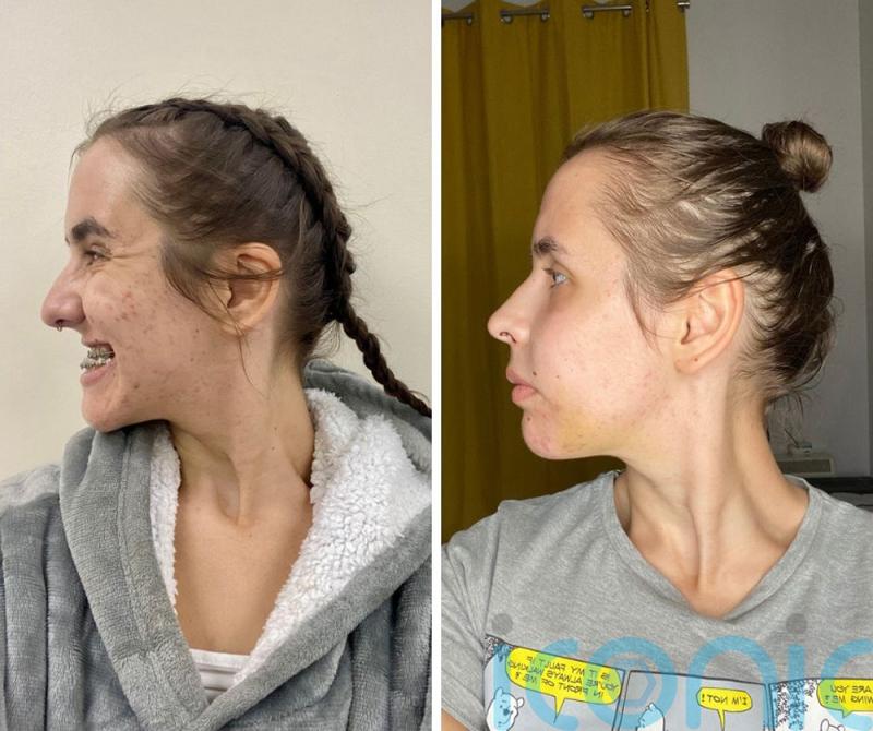 TikTok star looks like “cartoon character” as top jaw is 8mm too small until successful surgery which leaves her re-learning to “speak and kiss”