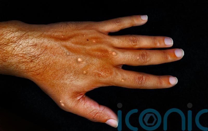 Worldwide monkeypox outbreak ‘concerning’ – Yousaf