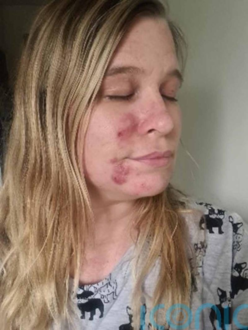 Mum felt “like a monster” and even hid her face from her daughter when she was struck with cystic acne after having Covid