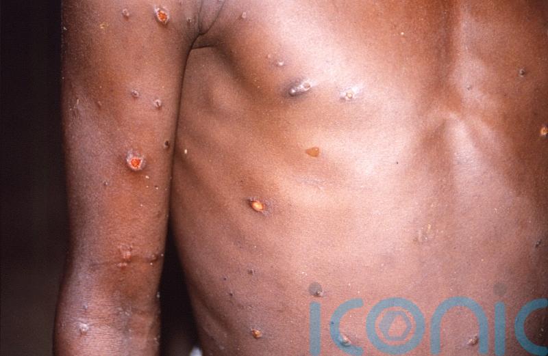 Number of monkeypox cases in UK beginning to plateau, figures suggest