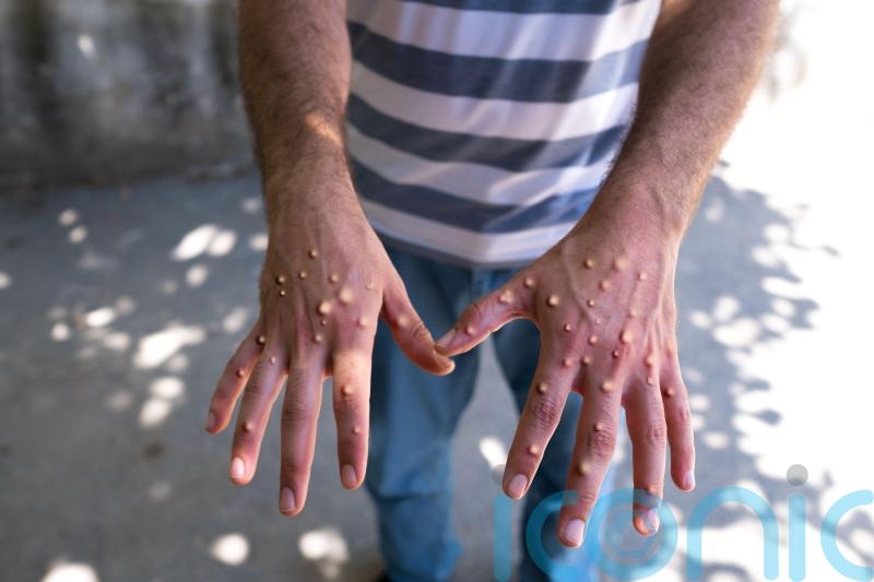 Advisory group on monkeypox will bring additional governance – CMO