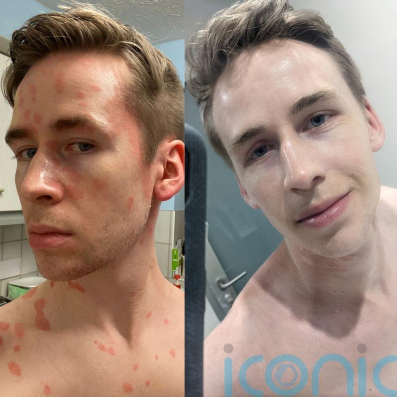 Man who “became a hermit” after waking to find himself covered in raindrop-size patches is “sassy” again thanks to a diet change and £19.99 cream