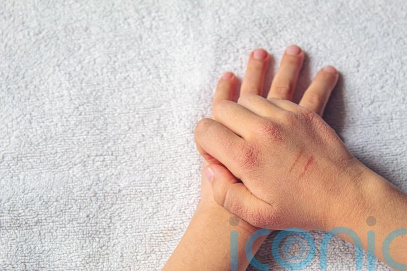 New drug therapy ‘highly effective’ for young children with severe eczema