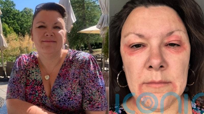 Woman who became a recluse after menopause-triggered eczema made her ‘look like a vampire’ praises ‘miracle’ cream cure