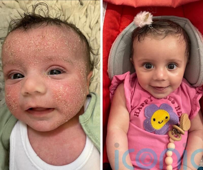 Adorable tot who wore mittens to stop her scratching her painful eczema now has ‘baby soft skin’ thanks to a £7.99 cream