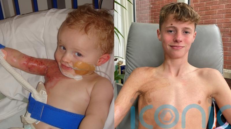 Mum feared her baby’s life was ruined after a boiling pan fell on him – now they’ve written an inspiring book together